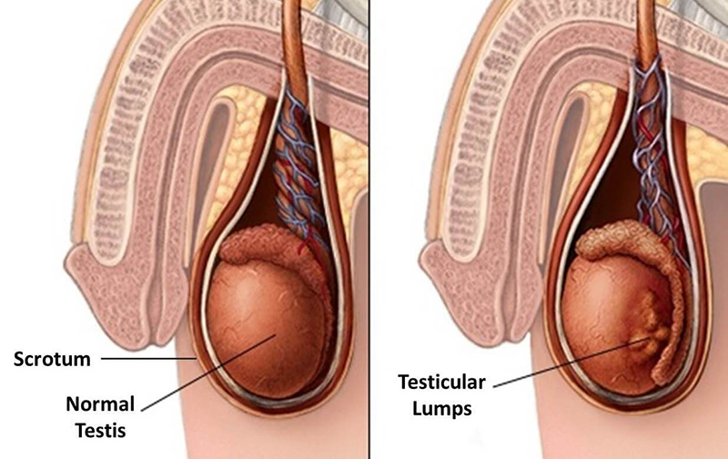 Viêm tinh hoàn là tác nhân gây vô sinh ở nam giới