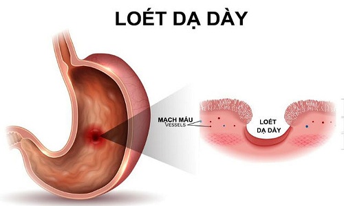 Biến chứng do bệnh viêm, loét dạ dày - tá tràng