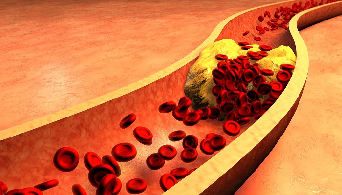 Cholesterol trong máu cao dẫn đến hình thành các mảng xơ vữa động mạch