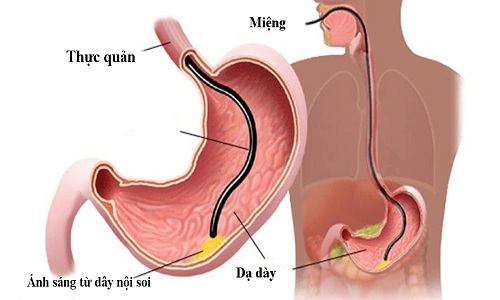 Nội soi dạ dày, đại tràng gây mê tại Bệnh viện đa khoa MEDLATEC