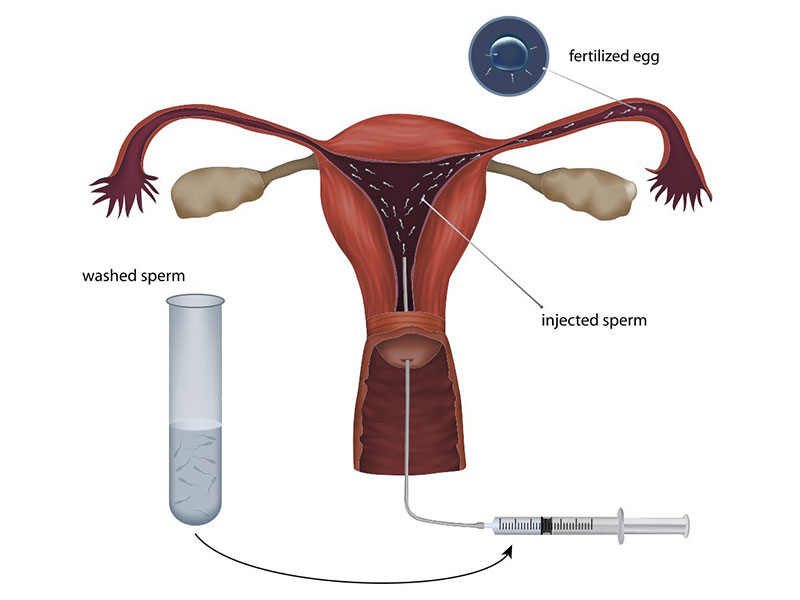 Mọi thao tác của kỹ thuật bơm tinh trùng phải được thực hiện trong môi trường vô khuẩn