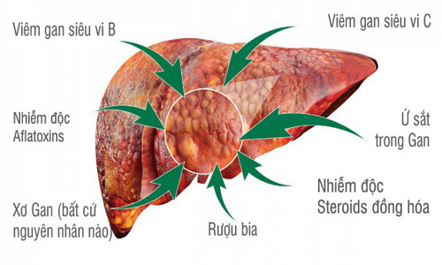 Dấu hiệu cảnh báo ung thư gan