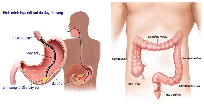 Nội soi đường ruột giúp sớm phát hiện ung thư