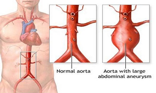 Phình động mạch chủ, bệnh cần được phát hiện sớm