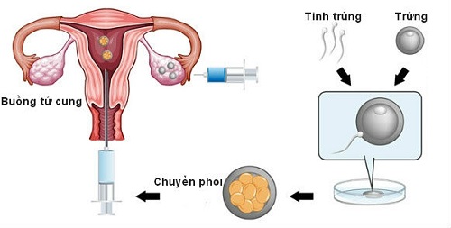 các phương pháp hỗ trợ sinh sản phổ biến hiện nay