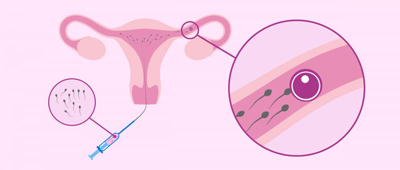 quá trình bơm tinh trùng diễn ra phụ thuộc vào trứng và tinh trùng của hai vợ chồng
