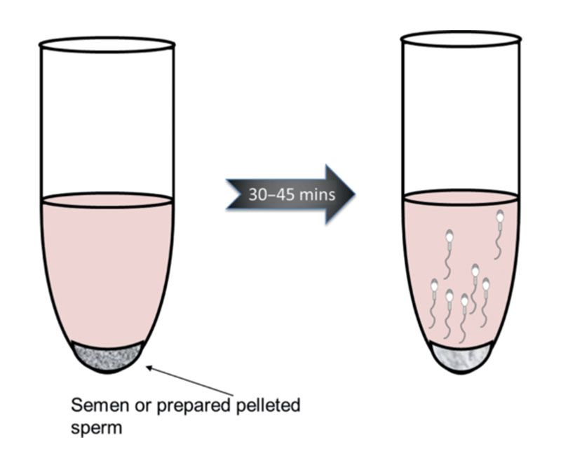 Quá trình lọc rửa tinh trùng