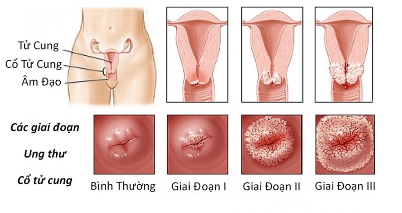 Ung thư cổ tử cung gây ảnh hưởng lớn đến sức khỏe nên cần thực hiện tầm soát từ sớm