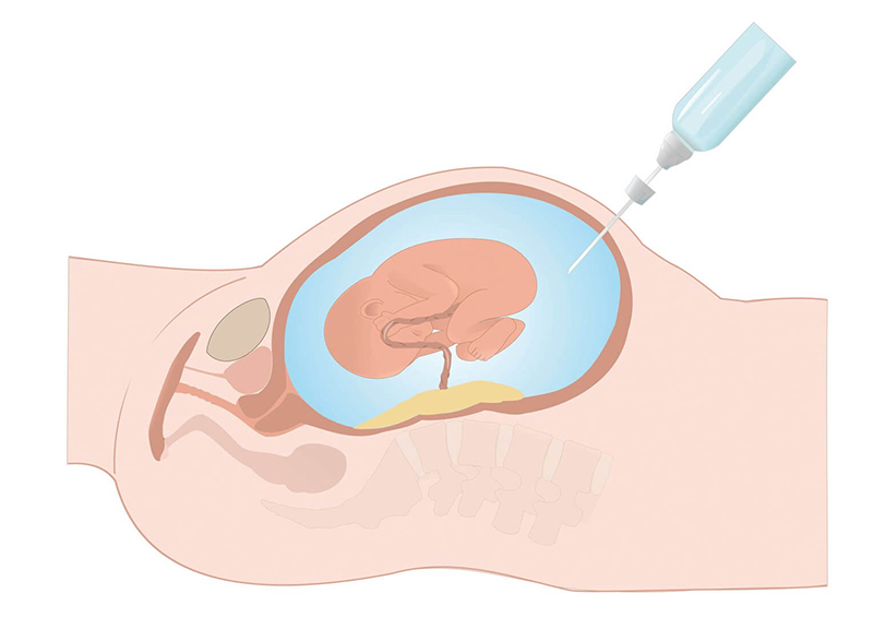 Phương pháp chọc ối hoàn toàn không gây nguy hiểm cho thai phụ nếu được thực hiện đúng cách 