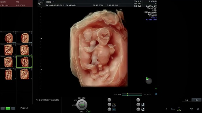 Những điều mẹ bầu cần lưu ý khi siêu âm 12 tuần: hình ảnh siêu âm 4D - Hình ảnh siêu âm 4D của thai nhi trong tuần thứ 12 sẽ được cung cấp để giúp mẹ bầu có thể theo dõi sự phát triển của con. Đến với chúng tôi để Biết thêm về các điều cần lưu ý trong quá trình siêu âm này.