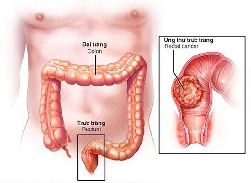 Trực tràng là phần dưới của hệ tiêu hóa trong cơ thể