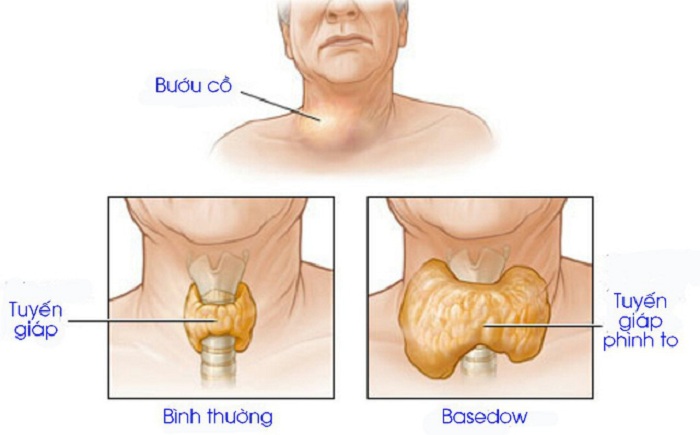 Siêu âm tuyến giáp nhanh chóng, chính xác tại Bệnh viện đa khoa MEDLATEC