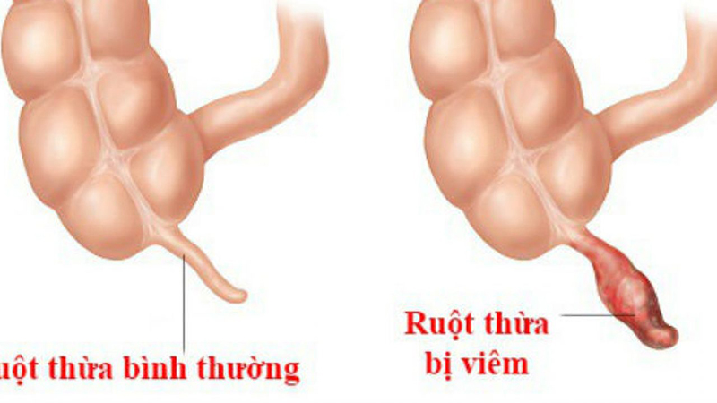 Viêm ruột thừa nếu không được điều trị kịp thời sẽ gây vỡ và dẫn đến nhiều hệ lụy khá nghiêm trọng về sau