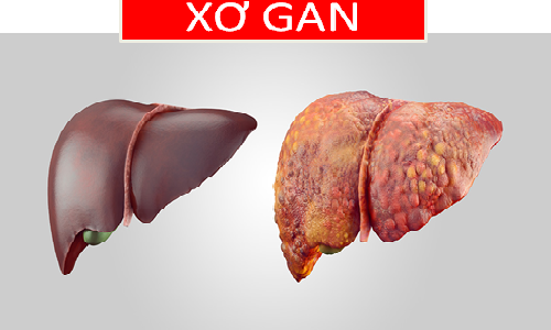 Hình ảnh gan bình thường và gan bị xơ