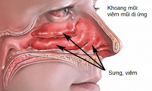 Phát hiện sớm ung thư tai mũi họng nhờ phương pháp nội soi bằng ống mềm tại MEDLATEC