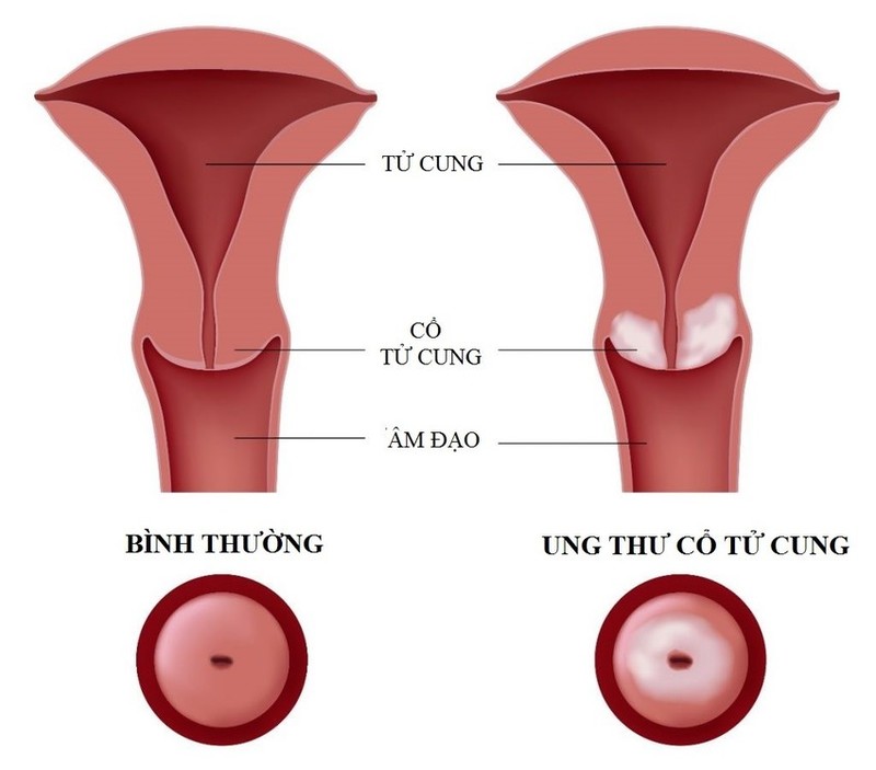 Chị em nên tầm soát ung thư cổ tử cung định kỳ để đảm bảo sức khỏe