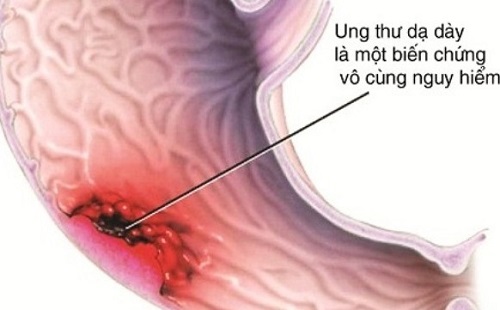 Tầm soát ung thư dạ dày tại MEDLATEC an toàn, nhanh chóng, chính xác