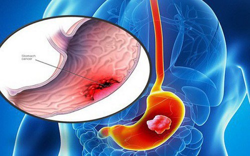 Tầm soát ung thư dạ dày tại MEDLATEC an toàn, nhanh chóng, chính xác