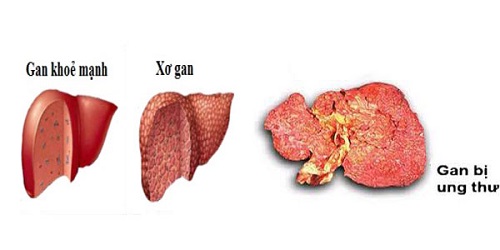 Tầm soát ung thư gan tại MEDLATEC an toàn, nhanh chóng, chính xác