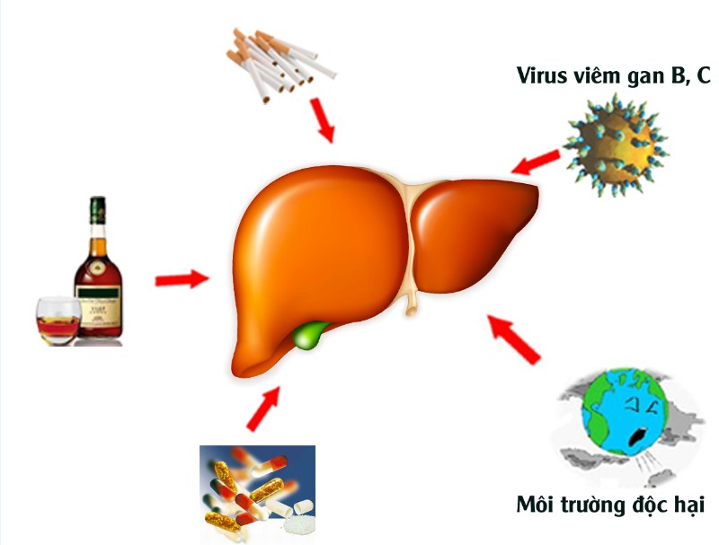 Có rất nhiều yếu tố tác động xấu đến gan do đó cần đi tầm soát ung thư gan sớm