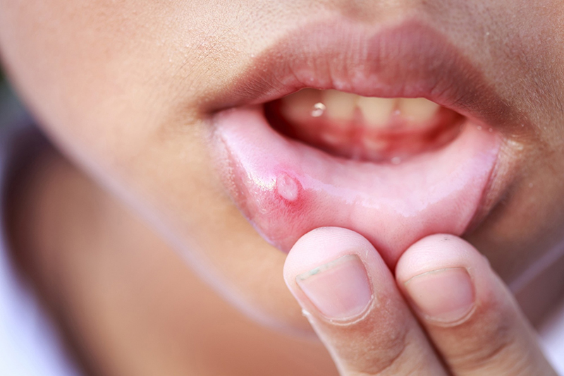 Vết loét bất thường có thể là dấu hiệu bạn nên tầm soát ung thư miệng