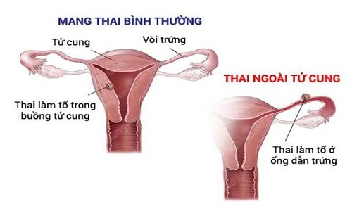 Chẩn đoán chính xác chửa ngoải tử cung, bệnh hiếm gặp ở thai phụ