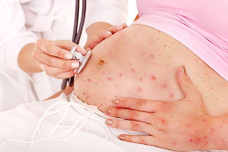 Bệnh Rubella rất nguy hiểm với phụ nữ mang thai