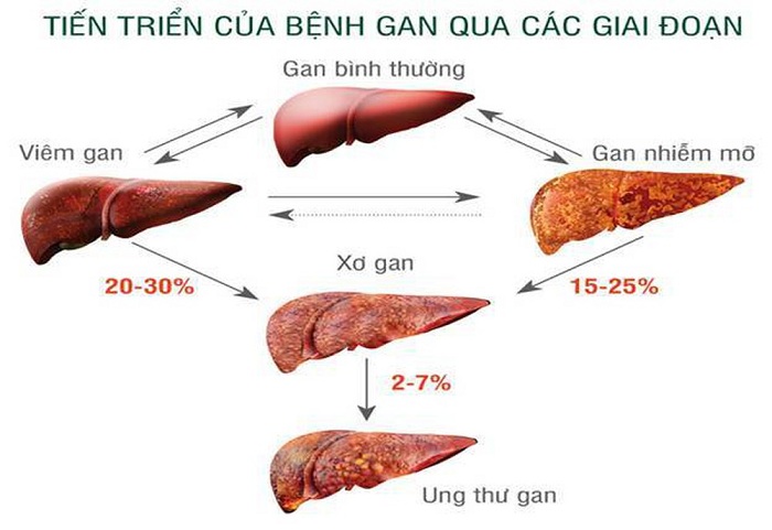 Xơ gan cổ trướng là gì và nguyên nhân do đâu?