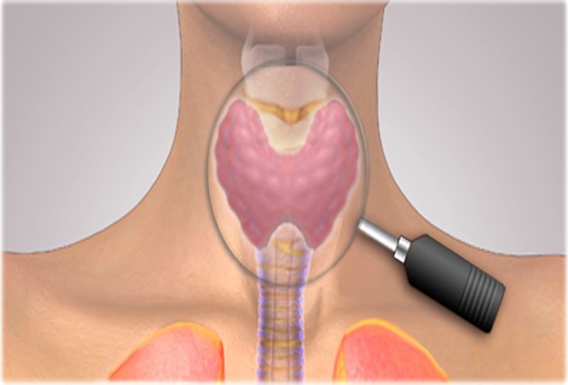 Chọc sinh thiết để xét nghiệm u tuyến giáp thể nhú