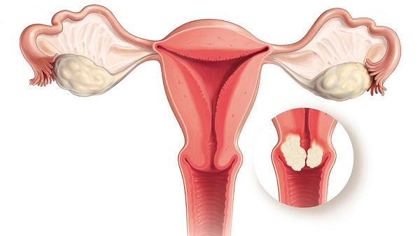 MEDLATEC khám, phát hiện ung thư cổ tử cung hiệu quả