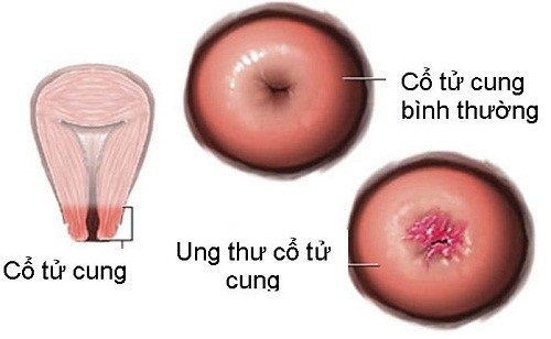 cổ tử cung bình thường và ung thư cổ tử cung