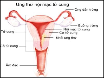 MEDLATEC xét nghiệm dấu ấn ung thư nhanh chóng, chính xác