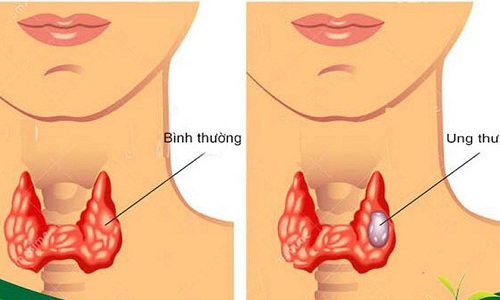 Xét nghiệm dấu ấn ung thư tuyến giáp