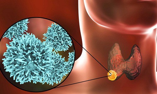 Các bệnh lý tuyến giáp có thể chữa khỏi nếu phát hiện ở giai đoạn sớm
