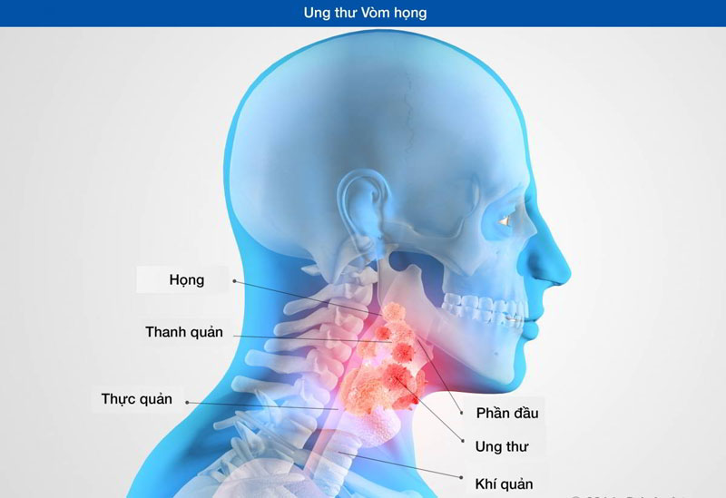 Ung thư vòm họng là một bệnh nguy hiểm