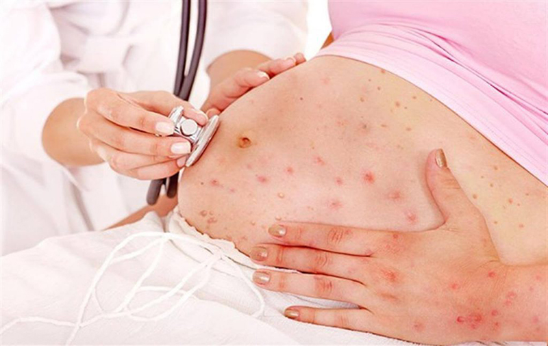 Biểu hiện của bệnh rubella trên cơ thể bà bầu