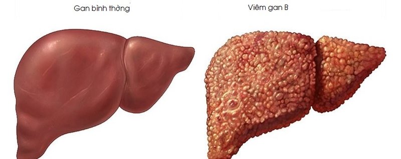 Viêm gan B có thể phát triển thành giai đoạn cấp tính, mạn tính và biến chứng dẫn đến xơ gan, ung thư gan