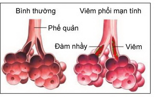 Viêm phế quản mạn tính (phải) không được điều trị đúng cách dễ dẫn đến viêm phổi tắc nghẽn mạn tính...