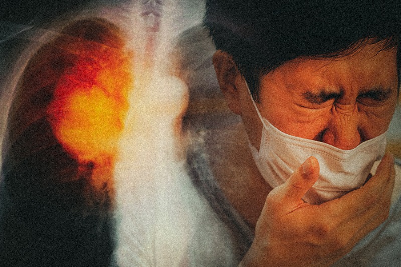Chẩn đoán 7 tác nhân gây viêm phổi cộng đồng chỉ bằng một xét nghiệm