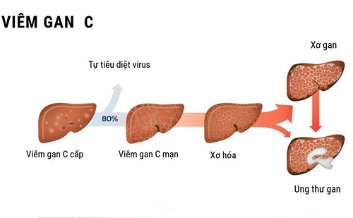 viêm gan C cần được phát hiện và điều trị kịp thời