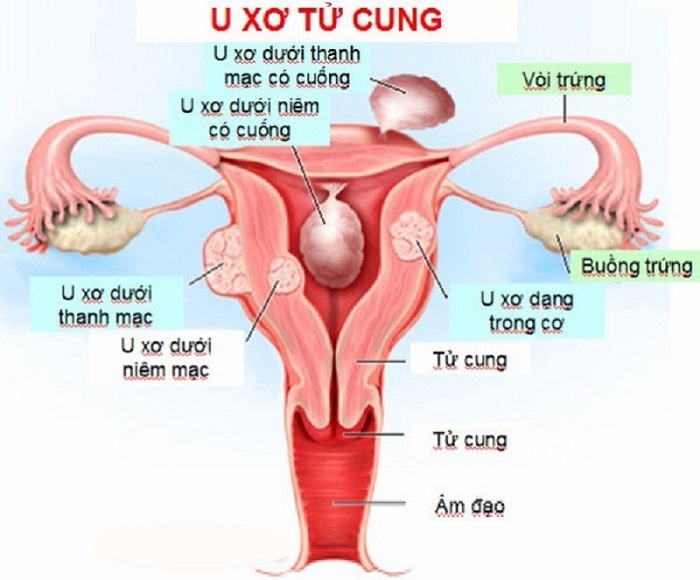 Bệnh lý tử cung là một trong những nguyên nhân gây vô sinh ở nữ giới