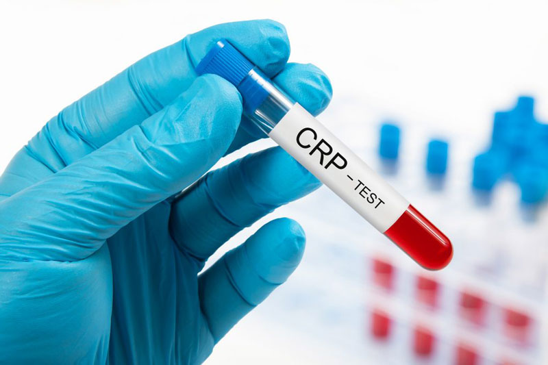 Xét nghiệm CRP cho biết bệnh gì, xét nghiệm ở đâu uy tín nhất? | Medlatec