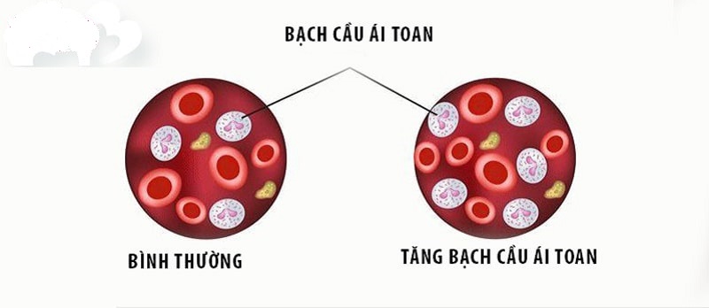 Bạch cầu ái toan tăng khi tràn dịch màng phổi do ký sinh trùng gây nên