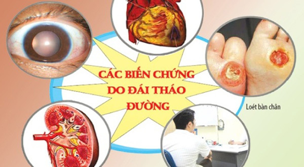 Đái tháo đường – bệnh lý mạn tính hay gặp có thể gây nhiều biến chứng nguy hiểm.