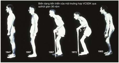 xét nghiệm HLA-B27 kiểm tra tình trạng viêm cột sống dính khớp