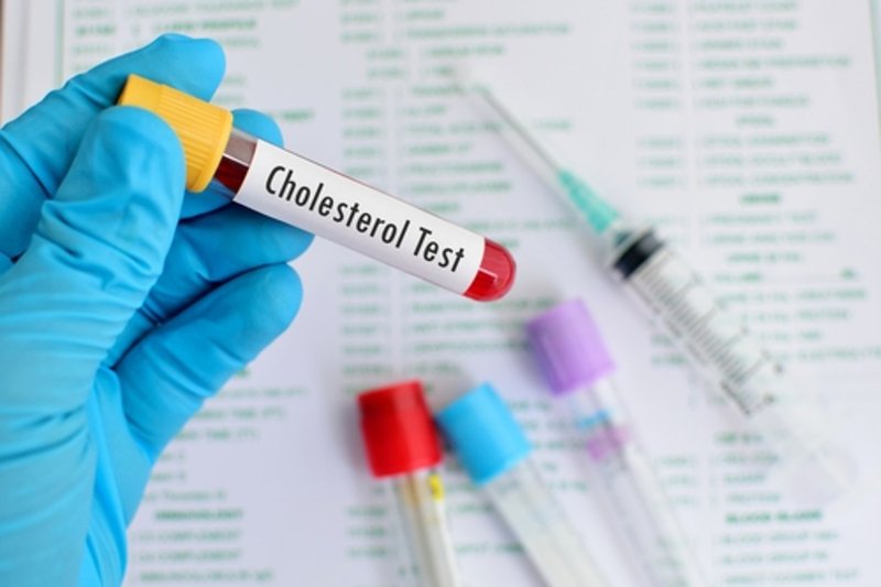 Xét nghiệm định lượng Cholesterol máu đóng vai trò quan trọng trong việc bảo vệ sức khỏe định kỳ