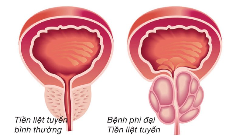 Phì đại tuyến tiền liệt lành tính cũng có thể khiến nồng độ PSA tăng cao