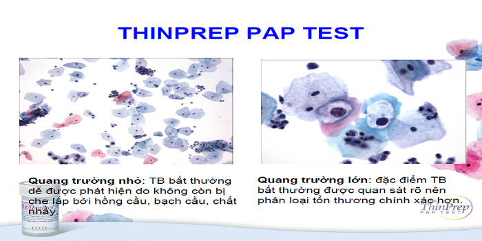 Xét nghiệm Thin prep được thực hiện trong tầm soát ung thư cổ tử cung