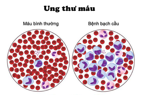 người mắc bệnh ung thư máu cần thực hiện xét nghiệm ung thư máu thường xuyên