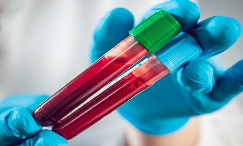 Bỏ túi các xét nghiệm nhiễm khuẩn huyết theo quy định của Bộ Y tế | Medlatec